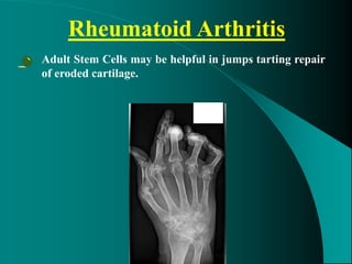 Rheumatoid Arthritis
• Adult Stem Cells may be helpful in jumps tarting repair
of eroded cartilage.
 