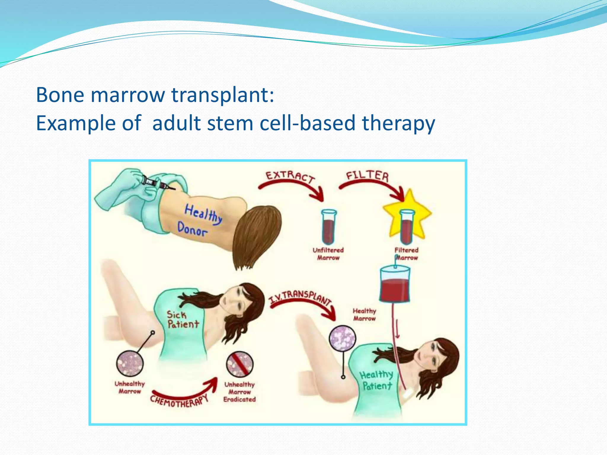 Bone marrow transplant:
Example of adult stem cell-based therapy
 