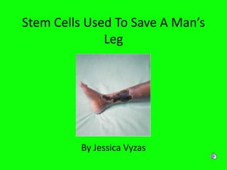 Stem Cells Used To Save A Man’s Leg By Jessica Vyzas 