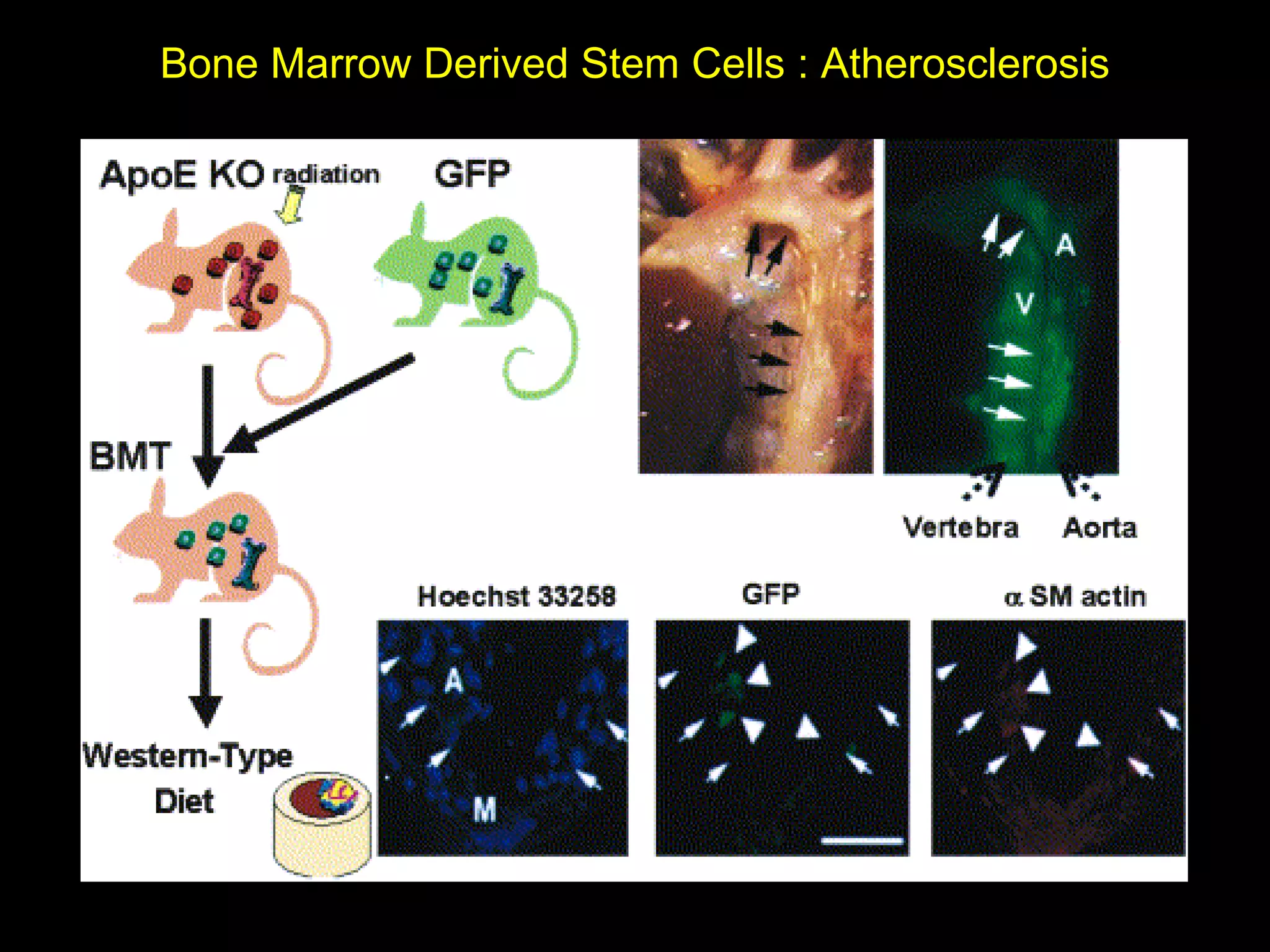 Bone Marrow Derived Stem Cells : Atherosclerosis 