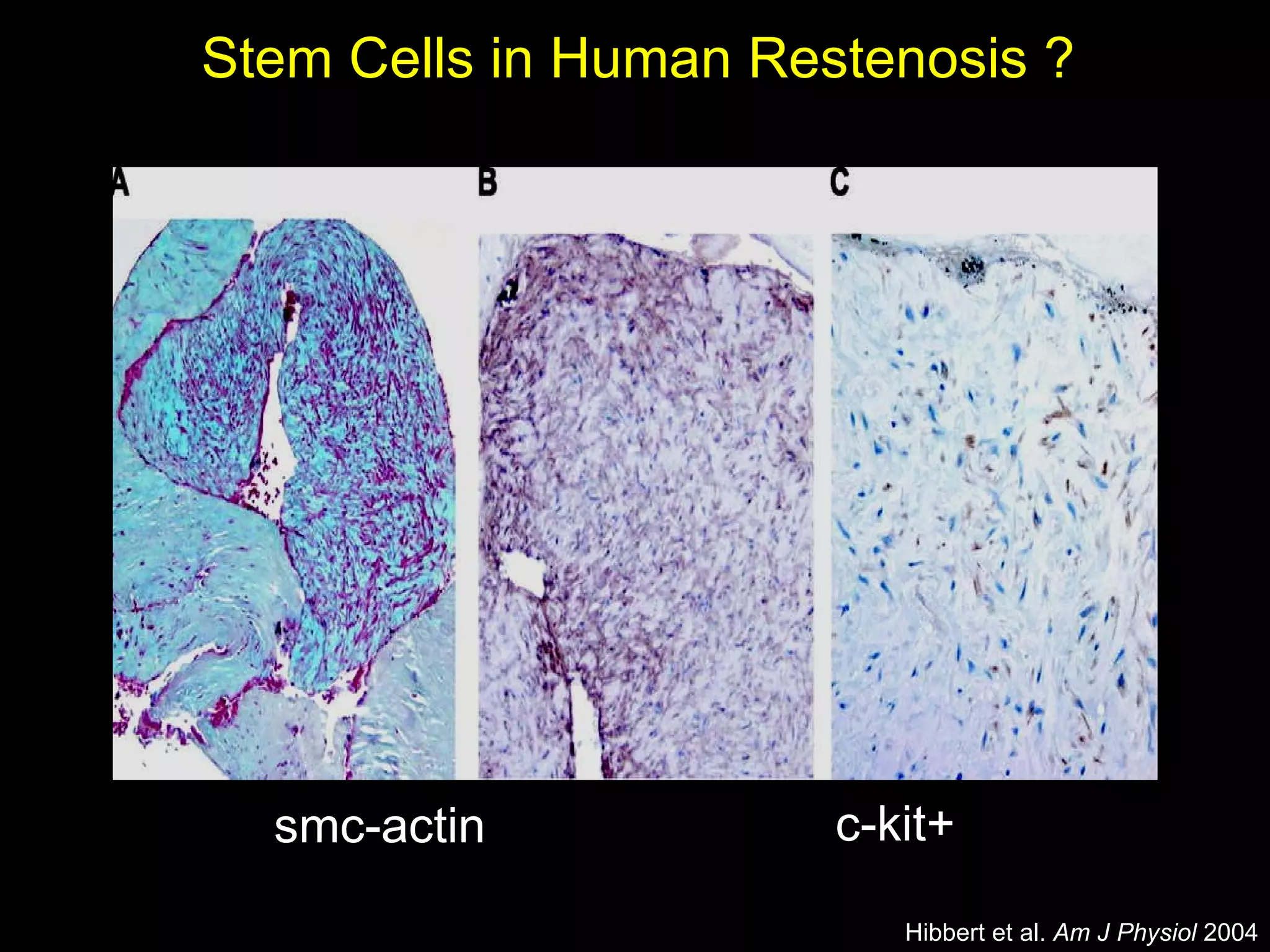 Stem Cells in Human Restenosis ? smc-actin c-kit+ Hibbert et al.  Am J Physiol  2004 