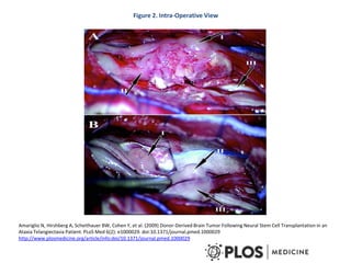 Figure 2. Intra-Operative View
Amariglio N, Hirshberg A, Scheithauer BW, Cohen Y, et al. (2009) Donor-Derived Brain Tumor Following Neural Stem Cell Transplantation in an
Ataxia Telangiectasia Patient. PLoS Med 6(2): e1000029. doi:10.1371/journal.pmed.1000029
http://www.plosmedicine.org/article/info:doi/10.1371/journal.pmed.1000029
 
