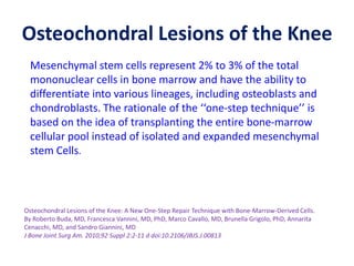 Osteochondral Lesions of the Knee
Osteochondral Lesions of the Knee: A New One-Step Repair Technique with Bone-Marrow-Derived Cells.
By Roberto Buda, MD, Francesca Vannini, MD, PhD, Marco Cavallo, MD, Brunella Grigolo, PhD, Annarita
Cenacchi, MD, and Sandro Giannini, MD
J Bone Joint Surg Am. 2010;92 Suppl 2:2-11 d doi:10.2106/JBJS.J.00813
Mesenchymal stem cells represent 2% to 3% of the total
mononuclear cells in bone marrow and have the ability to
differentiate into various lineages, including osteoblasts and
chondroblasts. The rationale of the ‘‘one-step technique’’ is
based on the idea of transplanting the entire bone-marrow
cellular pool instead of isolated and expanded mesenchymal
stem Cells.
 