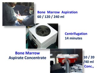 Bone Marrow Aspiration
60 / 120 / 240 ml
Centrifugation
14 minutes
10 / 20
/40 ml
Conc.,
Bone Marrow
Aspirate Concentrate
 