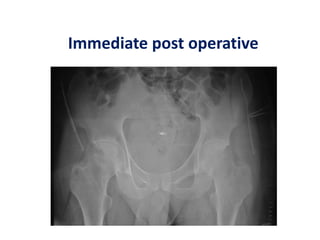 Immediate post operative
 