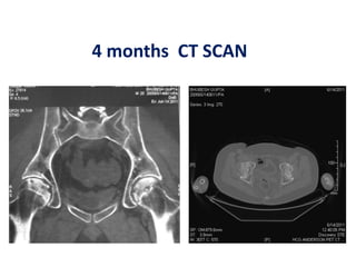 4 months CT SCAN
 