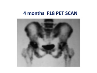 4 months F18 PET SCAN
 
