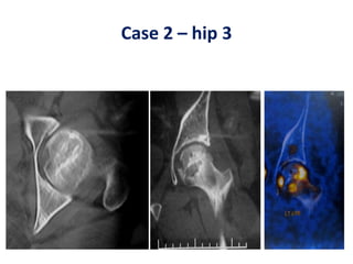 Case 2 – hip 3
 
