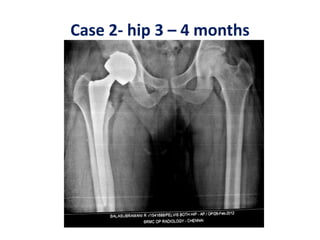 Case 2- hip 3 – 4 months
 