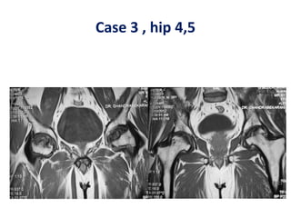 Case 3 , hip 4,5
 