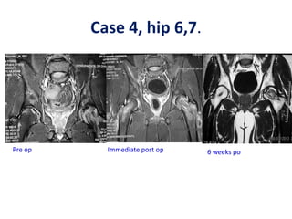 Case 4, hip 6,7.
Pre op Immediate post op 6 weeks po
 
