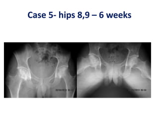 Case 5- hips 8,9 – 6 weeks
 