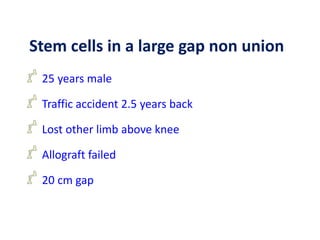 25 years male
Traffic accident 2.5 years back
Lost other limb above knee
Allograft failed
20 cm gap
Stem cells in a large gap non union
 