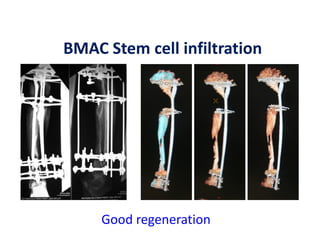 Good regeneration
BMAC Stem cell infiltration
 