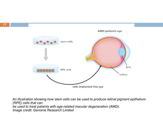 77
An illustration showing how stem cells can be used to produce retinal pigment epithelium
(RPE) cells that can
be used to treat patients with age-related macular degeneration (AMD).
Image credit: Genome Research Limited
 