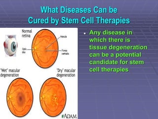 What Diseases Can be
Cured by Stem Cell Therapies
 Any disease in
which there is
tissue degeneration
can be a potential
c...