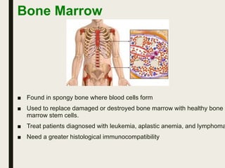 Bone Marrow
■ Found in spongy bone where blood cells form
■ Used to replace damaged or destroyed bone marrow with healthy bone
marrow stem cells.
■ Treat patients diagnosed with leukemia, aplastic anemia, and lymphoma
■ Need a greater histological immunocompatibility
 
