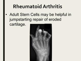 Rheumatoid Arthritis
• Adult Stem Cells may be helpful in
jumpstarting repair of eroded
cartilage.
 
