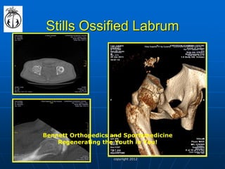 Stills Ossified Labrum 
Bennett Orthopedics and Sportsmedicine 
Regenerating the Youth in You! 
copyright 2012  