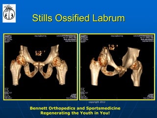 Stills Ossified Labrum 
Bennett Orthopedics and Sportsmedicine Regenerating the Youth in You! 
copyright 2012  