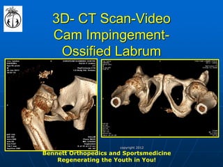 3D- CT Scan-Video Cam Impingement- Ossified Labrum 
Bennett Orthopedics and Sportsmedicine Regenerating the Youth in You! 
copyright 2012  