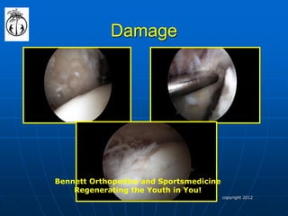 Damage 
Bennett Orthopedics and Sportsmedicine 
Regenerating the Youth in You! 
copyright 2012  
