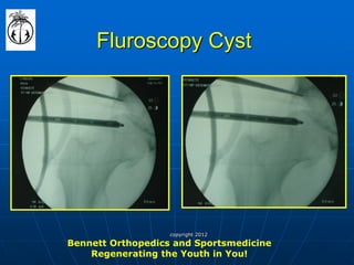 Fluroscopy Cyst 
Bennett Orthopedics and Sportsmedicine Regenerating the Youth in You! 
copyright 2012  