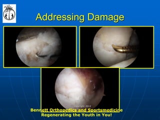 Addressing Damage 
Bennett Orthopedics and Sportsmedicine Regenerating the Youth in You! 
copyright 2012  