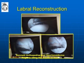 Labral Reconstruction 
Bennett Orthopedics and Sportsmedicine 
Regenerating the Youth in You! 
copyright 2012  