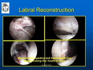 Labral Reconstruction 
Bennett Orthopedics and Sportsmedicine Regenerating the Youth in You! 
copyright 2012  