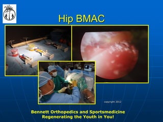 Hip BMAC 
Bennett Orthopedics and Sportsmedicine Regenerating the Youth in You! 
copyright 2012  