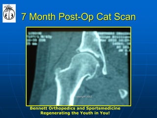 7 Month Post-Op Cat Scan 
Bennett Orthopedics and Sportsmedicine 
Regenerating the Youth in You! 
copyright 2012  