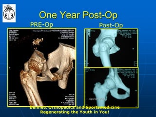 One Year Post-Op 
PRE-Op 
Post-Op 
Bennett Orthopedics and Sportsmedicine Regenerating the Youth in You! 
copyright 2012  