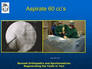Aspirate 60 cc’s 
Bennett Orthopedics and Sportsmedicine 
Regenerating the Youth in You! 
copyright 2012  