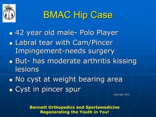 BMAC Hip Case 
42 year old male- Polo Player 
Labral tear with Cam/Pincer Impingement-needs surgery 
But- has moderate arthritis kissing lesions 
No cyst at weight bearing area 
Cyst in pincer spur 
Bennett Orthopedics and Sportsmedicine Regenerating the Youth in You! 
copyright 2012  