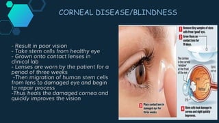 - Result in poor vision
- Take stem cells from healthy eye
- Grown onto contact lenses in
clinical lab
- Lenses are worn by the patient for a
period of three weeks
-Then migration of human stem cells
from lens to damaged eye and begin
to repair process
-Thus heals the damaged cornea and
quickly improves the vision
CORNEAL DISEASE/BLINDNESS
 