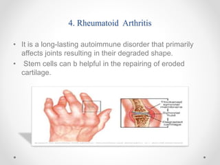 4. Rheumatoid Arthritis
• It is a long-lasting autoimmune disorder that primarily
affects joints resulting in their degraded shape.
• Stem cells can b helpful in the repairing of eroded
cartilage.
 