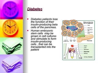 Diabetes   Diabetes patients lose the function of their insulin-producing beta cells of the pancreas. Human embryonic stem cells  may be grown in cell cultures and stimulate to form insulin-producing cells , that can be transplanted into the patient 