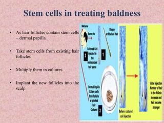 Stem cells in treating baldness
• As hair follicles contain stem cells
– dermal papilla
• Take stem cells from existing hair
follicles
• Multiply them in cultures
• Implant the new follicles into the
scalp
 