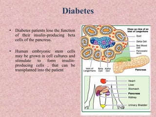 Diabetes
• Diabetes patients lose the function
of their insulin-producing beta
cells of the pancreas.
• Human embryonic stem cells
may be grown in cell cultures and
stimulate to form insulin-
producing cells , that can be
transplanted into the patient
 