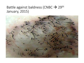 Battle against baldness (CNBC  29th
January, 2015)
 