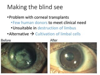 Making the blind see
•Problem with corneal transplants
•Few human donors to meet clinical need
•Unsuitable in destruction of limbus
•Alternative  Cultivation of limbal cells
 