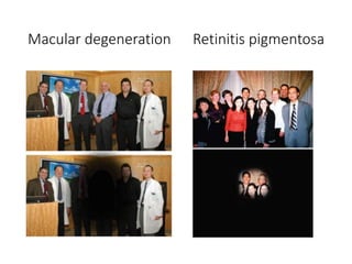 Macular degeneration Retinitis pigmentosa
 