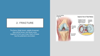 2. FRACTURE
The femur (thigh bone), patella (kneecap),
tibia (shine bone), and fibula come
together to form your knee. Each of these
has the potential to be broken
 