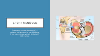 3.TORN MENISCUS
The anterior cruciate ligament (ACL)
connects your shinbone to your thighbone.
If you are an athlete, you are familiar with
ACL injuries.
 