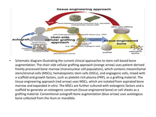 • Schematic diagram illustrating the current clinical approaches to stem-cell-based bone
augmentation. The chair-side cellular grafting approach (orange arrow) uses patient-derived
freshly processed bone marrow (mononuclear cell population), which contains mesenchymal
stem/stromal cells (MSCs), hematopoietic stem cells (HSCs), and angiogenic cells, mixed with
a scaffold and growth factors, such as platelet-rich plasma (PRP), as a grafting material. The
tissue engineering approach (red arrow) uses MSCs, which are isolated from aspirated bone
marrow and expanded in vitro. The MSCs are further cultured with osteogenic factors and a
scaffold to generate an osteogenic construct (tissue-engineered bone) or cell sheets as a
grafting material. Conventional autograft bone augmentation (blue arrow) uses autologous
bone collected from the ilium or mandible.
 