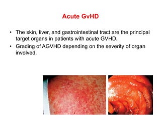 Acute GvHD
• The skin, liver, and gastrointestinal tract are the principal
target organs in patients with acute GVHD.
• Grading of AGVHD depending on the severity of organ
involved.
 