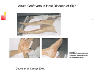 Couriel et al, Cancer 2004.
Acute Graft versus Host Disease of Skin
 