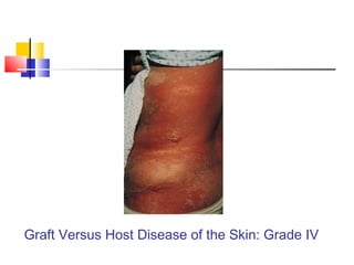Graft Versus Host Disease of the Skin: Grade IV
 