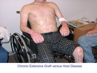 Chronic Extensive Graft versus Host Disease
 